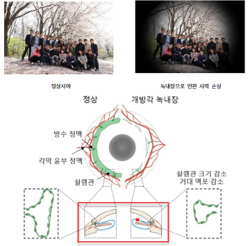 그림1. 녹내장 증상과 원인